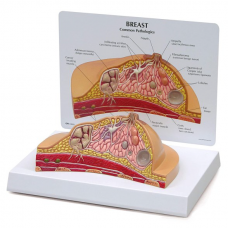 Human Body Anatomy Replica of Breast w/Common Pathologies